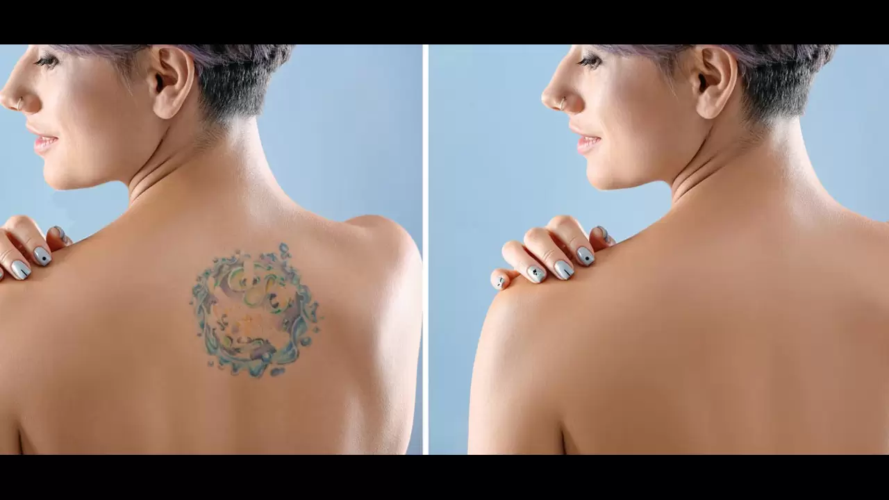 Erase the Past and Start Fresh with Our Tattoo Removal Services! in McKinney, TX