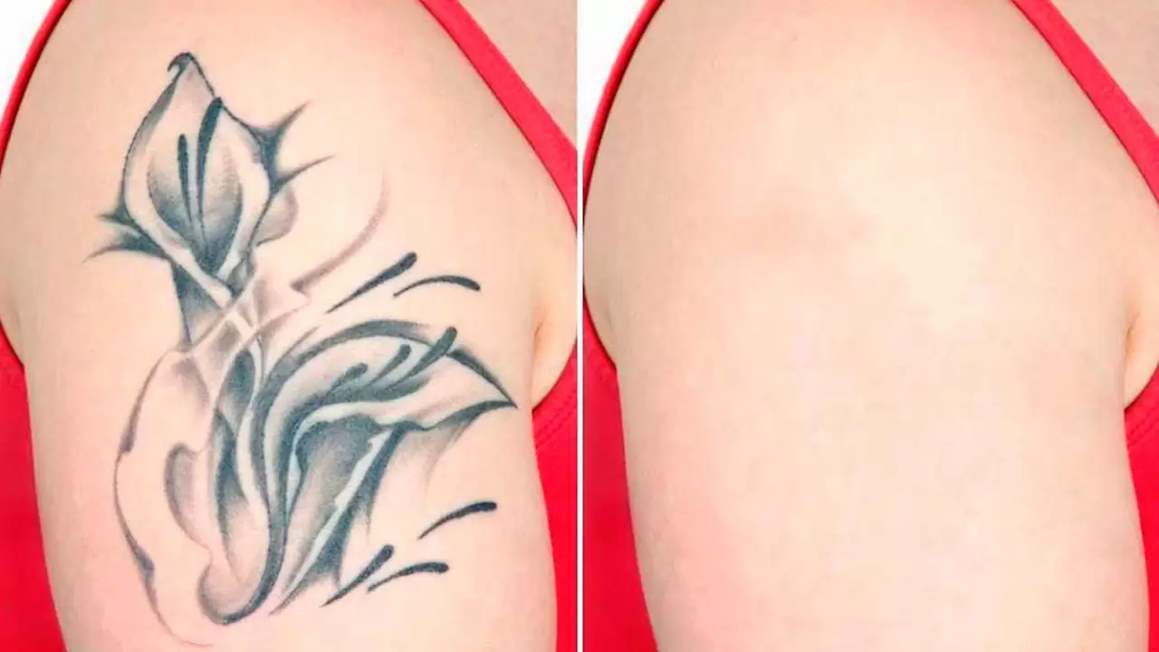 Tattoo Removal Cost is Affordable at Us! in Allen, TX