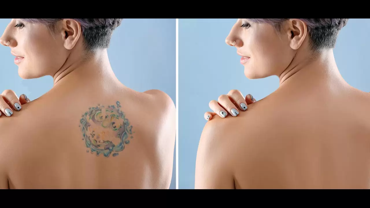 Tattoo Removal Services to Get Rid of Your Past! in Garland, TX