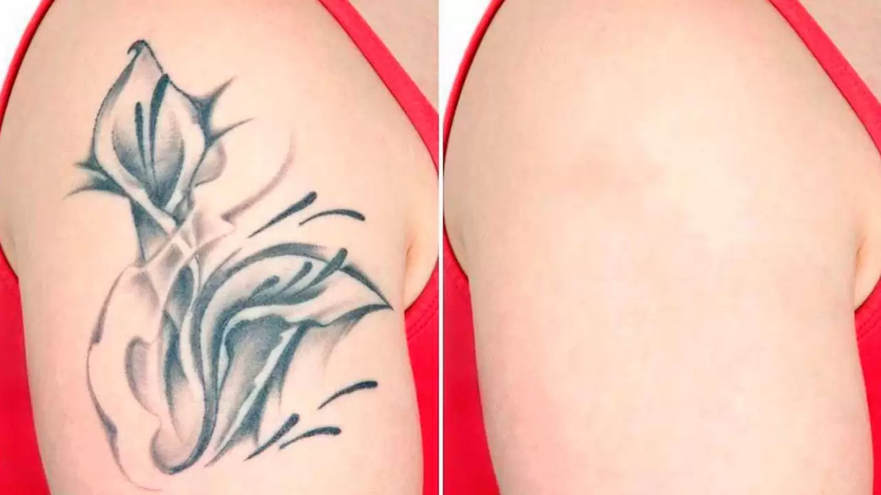 Tattoo Removal Cost that Won’t Cut Your Pocket! in Garland, TX