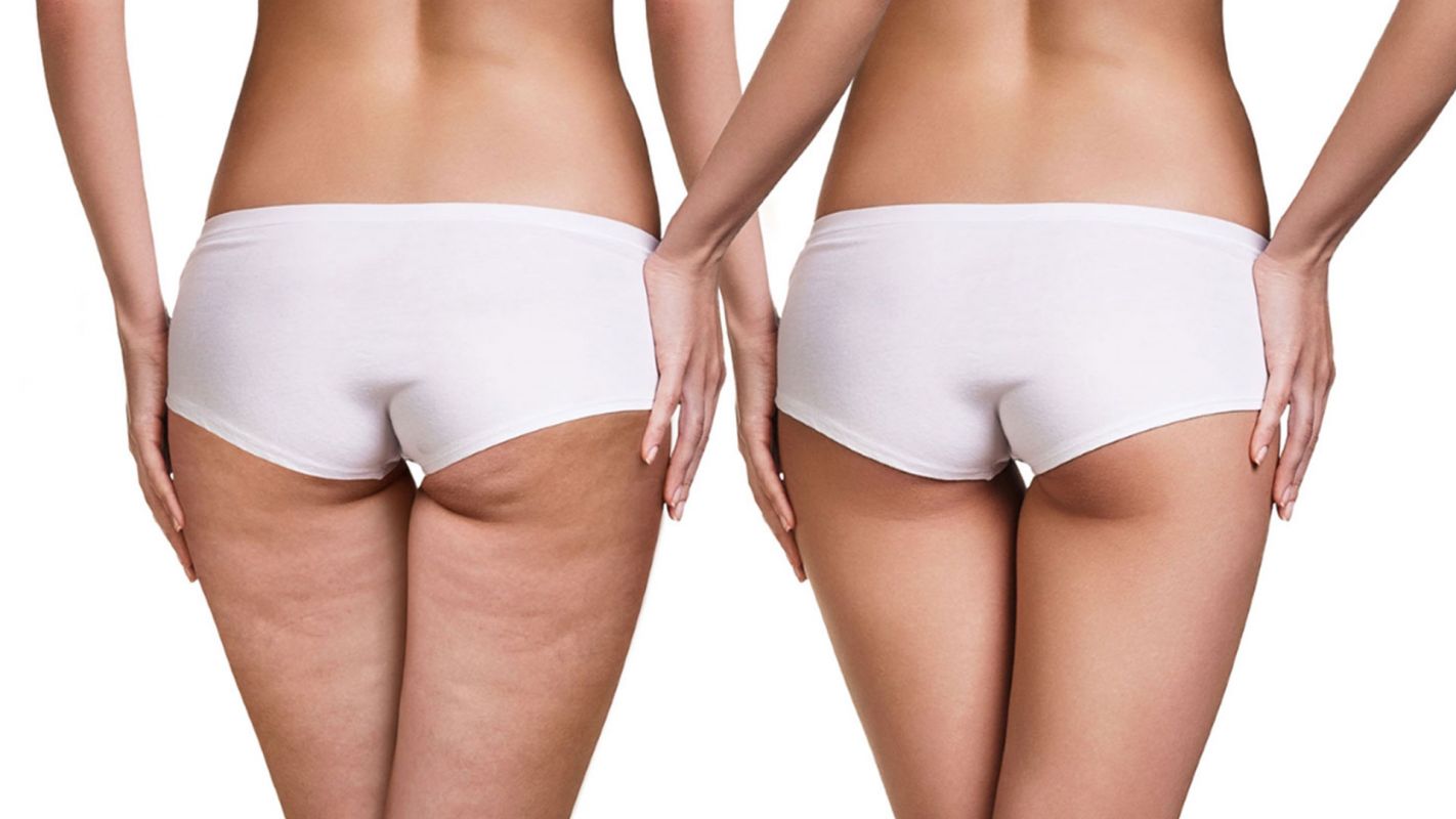 Cellulite Treatment Roswell GA