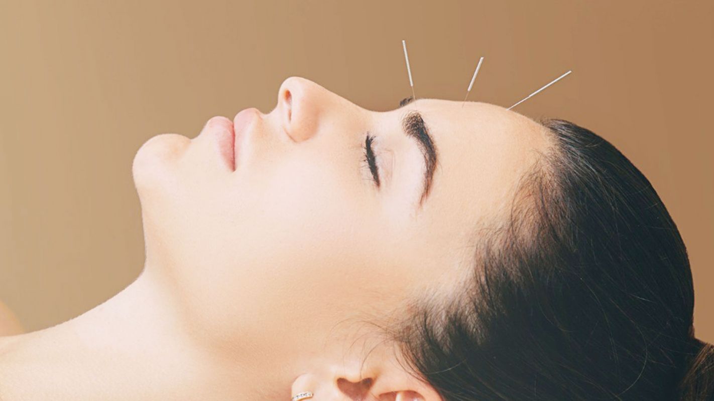 Acupuncture Service Columbia MD