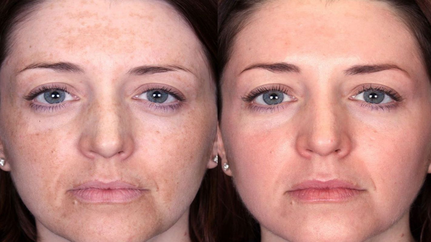 Glycolic Acid Chemical Peel Buckhead Atlanta GA