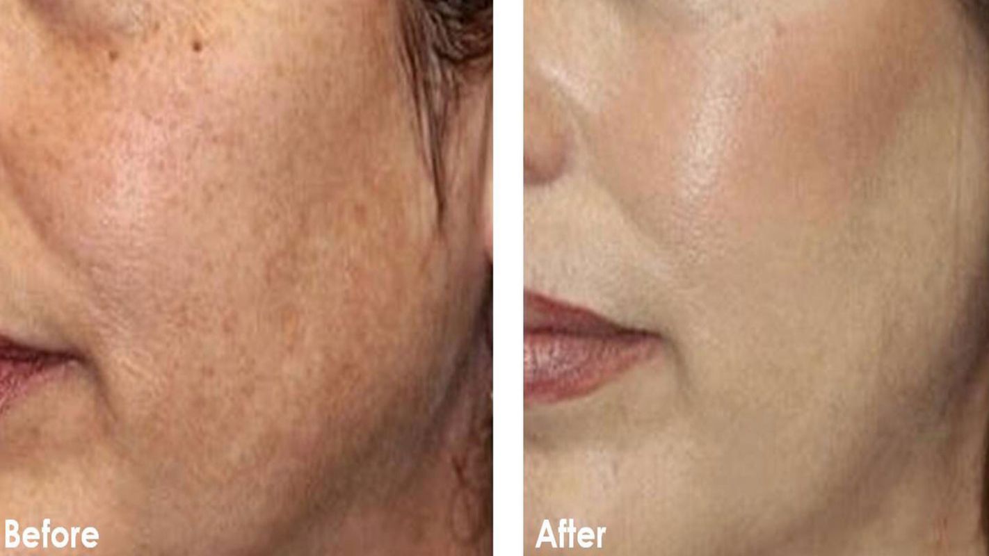 TCA Chemical Peel Buckhead Atlanta GA