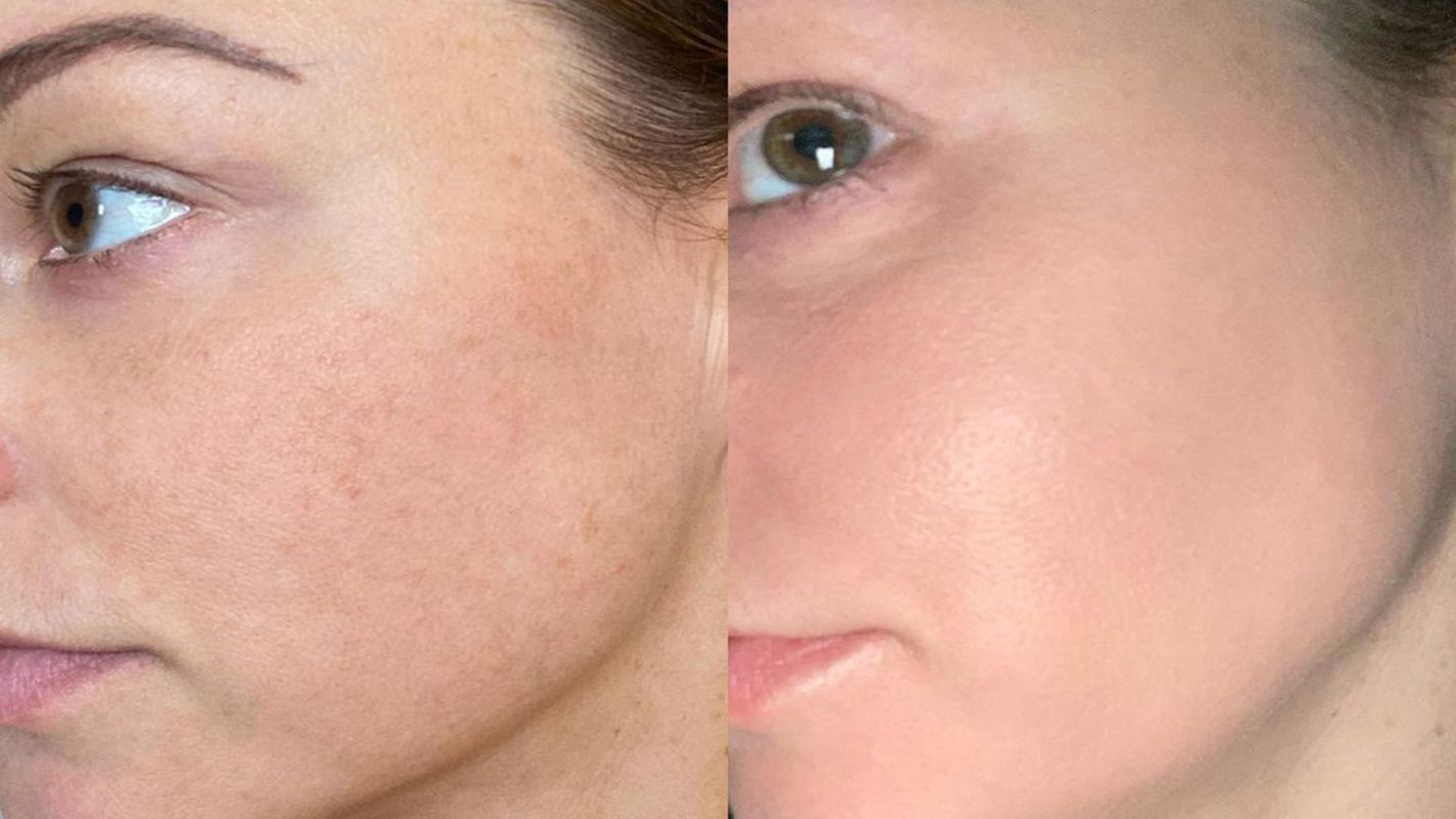 Enlighten Peel Atlanta GA