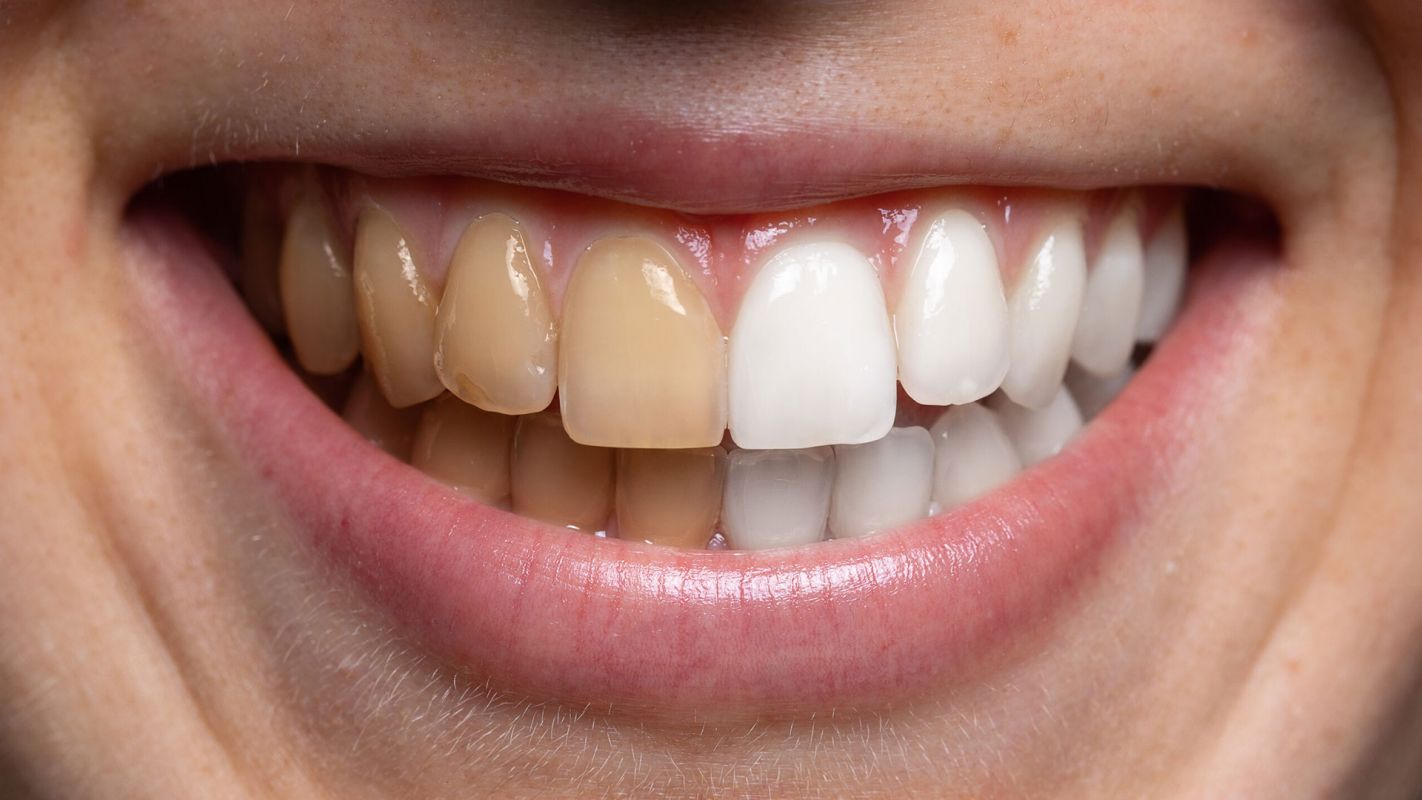 Teeth Whitening Farmington Hills MI