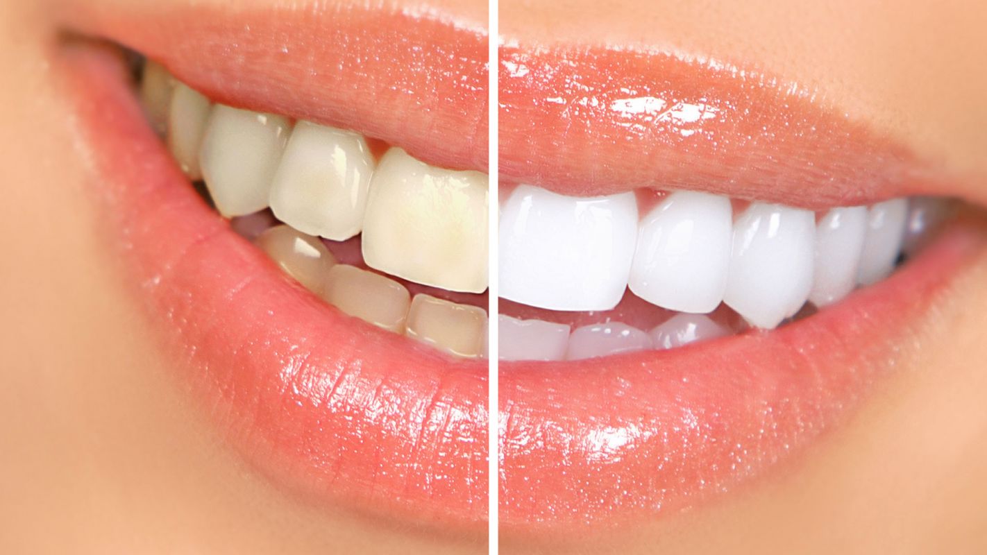 Teeth Whitening Treatment Bloomfield Hills MI