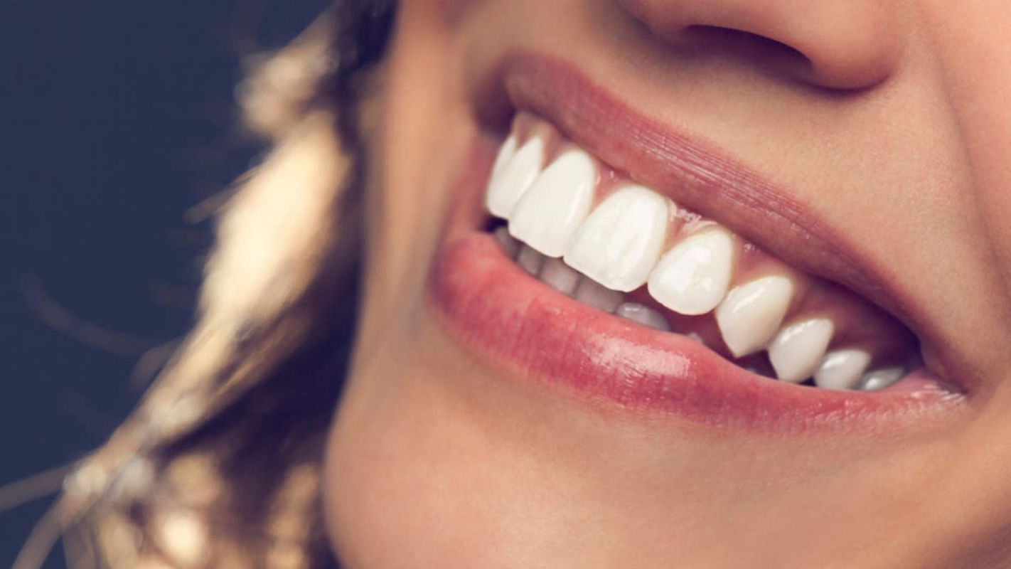 Teeth Whitening Troy MI