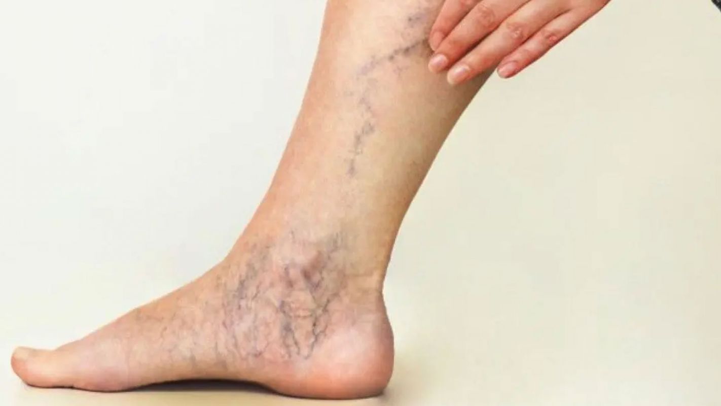 Blood Clot Legs Treatment Jackson MI