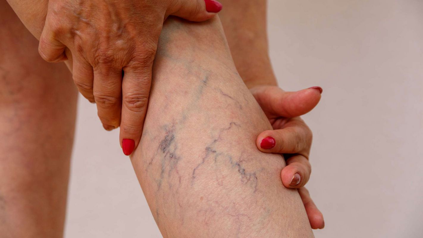 Bulging Veins Treatment Specialist Jackson MI