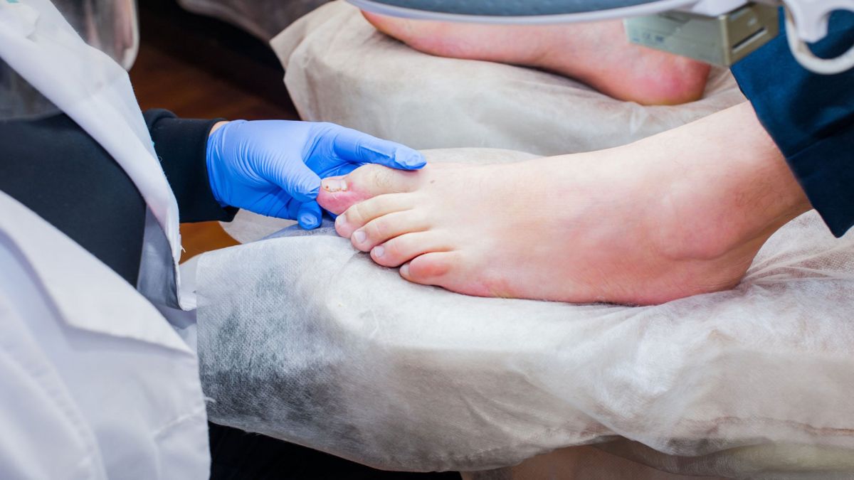 Ingrown Toenail Surgery Severna Park MD